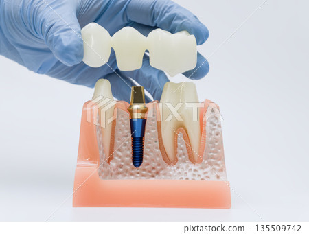 Dental bridge placement above implant in jaw model Dental bridge placement above implant in jaw model 135509742