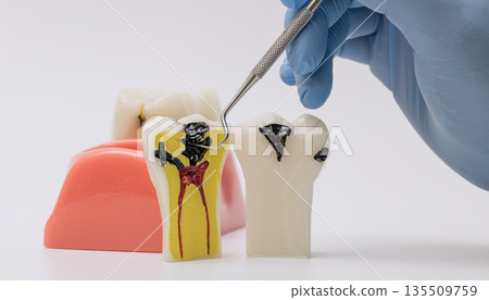Educational dental model displaying severe tooth decay and pulp infection in cross-section Educational dental model displaying severe tooth decay and pulp infection in cross-section 135509759