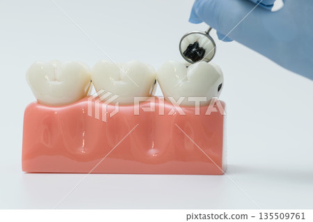 Dental mirror examining severe tooth decay on model 135509761