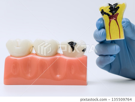Tooth decay model and pulp infection cross-section 135509764