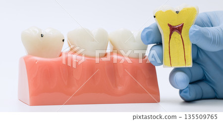 Tooth model with early decay and cross-section pulp anatomy 135509765