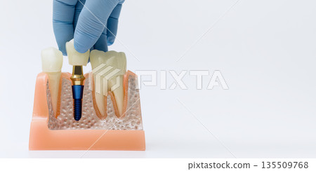 Dental implant placement model held by gloved hand Dental implant placement model held by gloved hand 135509768