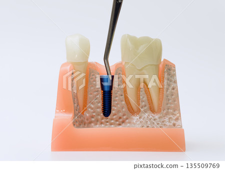 Dental implant model with tool pointing at titanium screw Dental implant model with tool pointing at titanium screw 135509769