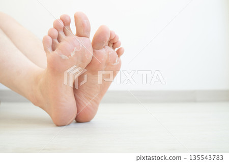 Close up of peeling and cracked foot. Causes of peeling foot included fungal infection (athlete's foot), dermatitis (eczema), sunburn, dry skin, dehydration or sweaty feet. Health care concept. Close up of peeling and cracked foot. Causes of peeling foot included fungal infection (athlete's foot), dermatitis (eczema), sunburn, dry skin, dehydration or sweaty feet. Health care concept. 135543783