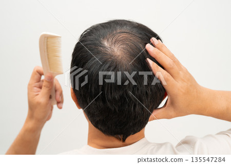 Bald in the middle head and begin no loss hair glabrous of mature man. Bald in the middle head and begin no loss hair glabrous of mature man. 135547284