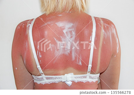 Print of brassiere on female body after beach. Body care Print of brassiere on female body after beach. Body care 135566278