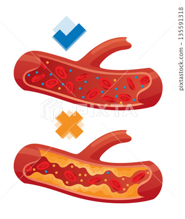 Types of cholesterol in human blood vessels. Normal and narrowed artery for explanation diseases. High-Density Lipoprotein HDL and Low-Density Lipoprotein LDL. Vector illustration Types of cholesterol in human blood vessels. Normal and narrowed artery for explanation diseases. High-Density Lipoprotein HDL and Low-Density Lipoprotein LDL. Vector illustration 135591318