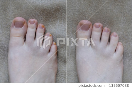 Close-up of damaged human nails showing discoloration, thickening, and separation. Concept of onycholysis, onychomycosis, hyperkeratosis, nail fungus, chromonychia, fungal infection Close-up of damaged human nails showing discoloration, thickening, and separation. Concept of onycholysis, onychomycosis, hyperkeratosis, nail fungus, chromonychia, fungal infection 135607088