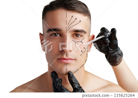 Man receiving facial marking for cosmetic procedure in a clinical setting 135625264