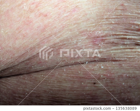 abdominal inflammation abdominal inflammation 135638089