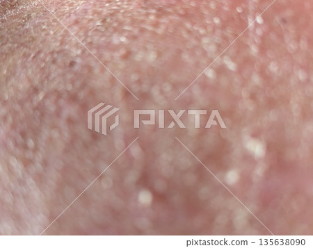 特應性皮炎 特應性皮炎 135638090