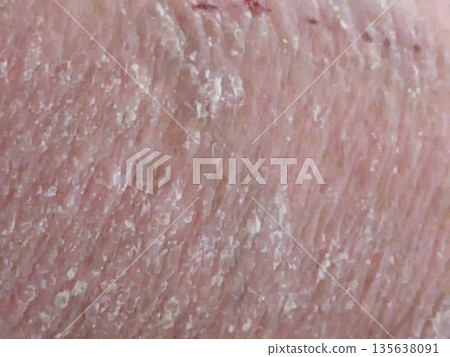 腹部發炎 腹部發炎 135638091