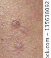 Dermatitis 135638092