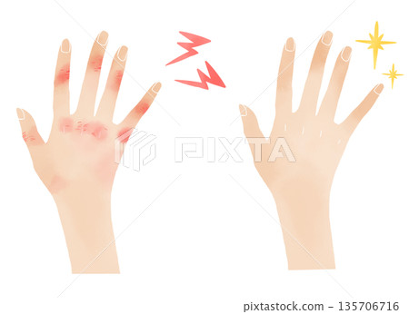 Watercolor hand care material - Before and after illustrations of chilblains 135706716