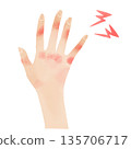 Watercolor style hand illustration of red, swollen chilblains and chapped skin 135706717