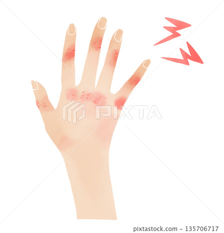 Watercolor style hand illustration of red, swollen chilblains and chapped skin Watercolor style hand illustration of red, swollen chilblains and chapped skin 135706717