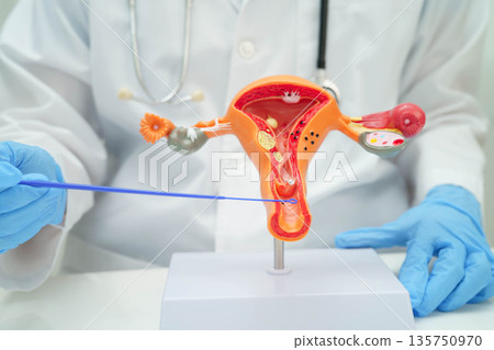Uterus, doctor holding human anatomy model for study diagnosis and treatment in hospital. Uterus, doctor holding human anatomy model for study diagnosis and treatment in hospital. 135750970