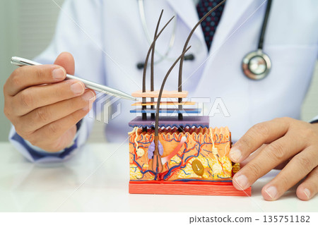Hair transplant, Asian dermatologist doctor holding skin structure anatomy model for treatment in hospital. Hair transplant, Asian dermatologist doctor holding skin structure anatomy model for treatment in hospital. 135751182