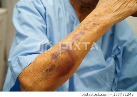 Ecchymosis, elderly bleeding on her arm after taking aspirin. Ecchymosis, elderly bleeding on her arm after taking aspirin. 135751242