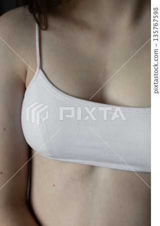 girl in white top with scar from heart surgery. Concept of medicine, health, beauty, psychology. 135767598