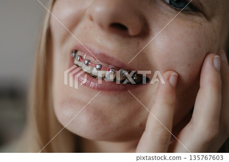 woman shows off her teeth with braces. Suitable for topics such as health, medicine, and dentistry. woman shows off her teeth with braces. Suitable for topics such as health, medicine, and dentistry. 135767603