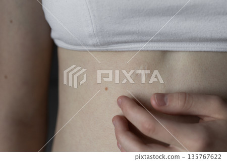 girl in white top with scar on her body from surgery Concept of medicine, health, beauty, psychology 135767622