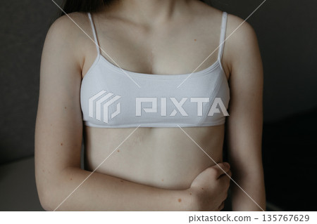 girl in white top with scar from heart surgery. Concept of medicine, health, beauty, psychology. girl in white top with scar from heart surgery. Concept of medicine, health, beauty, psychology. 135767629