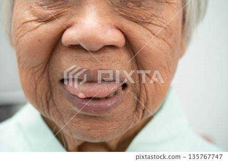 Cysts at the tongue in mouth of Asian elderly old lady woman patient. Cysts at the tongue in mouth of Asian elderly old lady woman patient. 135767747