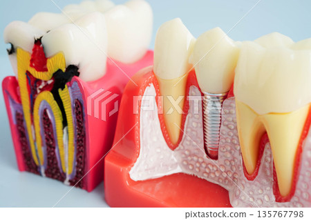Dental teeth model on white background for learn about dentistry. Dental teeth model on white background for learn about dentistry. 135767798