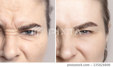 Collage photo Caucasian woman with wrinkles on the bridge of her nose and between the eyebrows and portrait after visiting a cosmetologist. Close up photo 135828806