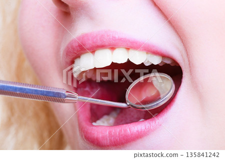 Woman teeth and dentist mouth mirror Woman teeth and dentist mouth mirror 135841242