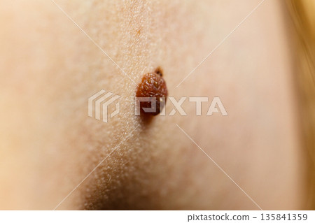 Closeup brown mole on skin. 135841359