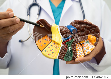 Cirrhosis, Liver cancer, fatty liver, Asian doctor with liver human model. 135862917