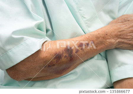 Ecchymosis, elderly bleeding on her arm after taking aspirin. Ecchymosis, elderly bleeding on her arm after taking aspirin. 135866677