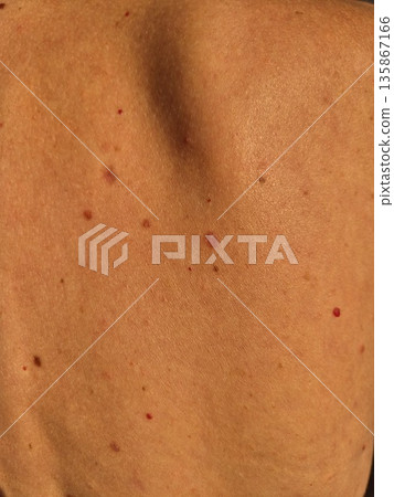 Close-up of human skin with multiple moles and pigmented nevi on the back. Close-up of human skin with multiple moles and pigmented nevi on the back. 135867166