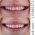 Female six frontal teeth makeover with ceramic ultra-thin aesthetic veneers. Before and after 135885273