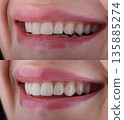 Female six frontal teeth makeover with ceramic ultra-thin aesthetic veneers. Before and after 135885274