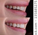 Female six frontal teeth makeover with ceramic ultra-thin aesthetic veneers. Before and after 135885275