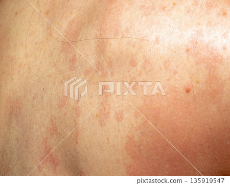 Psoriasis on skin Psoriasis on skin 135919547