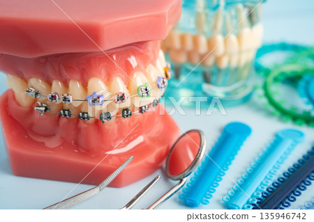 Orthodontic ligatures rings and ties, elastic rubber bands on orthodontic braces, model for dentist studying about dentistry. 135946742
