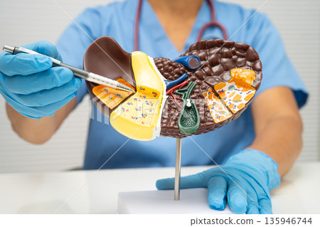 Cirrhosis, Liver cancer, fatty liver, Asian woman with liver human anatomy model. 135946744
