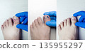 Before and after podiatry treatment of ingrown toenail using nail tamponade. Conservative medical care shows reduced inflammation, corrected nail growth and toe healing. 135955297