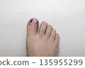 Medical pedicure treatment showing toe nail tamponade to prevent ingrown toenail. Podiatry procedure with cotton packing, antiseptic care and nail correction. 135955299