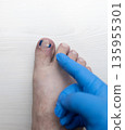 Medical pedicure treatment showing toe nail tamponade to prevent ingrown toenail. Podiatry procedure with cotton packing, antiseptic care and nail correction. 135955301