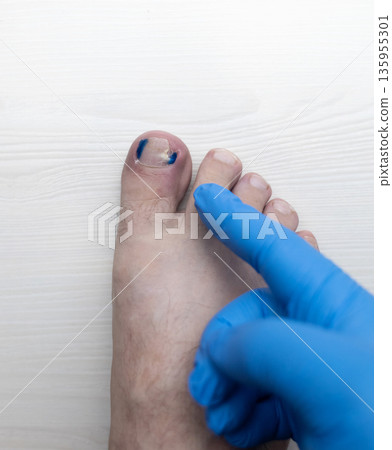 Medical pedicure treatment showing toe nail tamponade to prevent ingrown toenail. Podiatry procedure with cotton packing, antiseptic care and nail correction. Medical pedicure treatment showing toe nail tamponade to prevent ingrown toenail. Podiatry procedure with cotton packing, antiseptic care and nail correction. 135955301