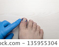 Medical pedicure treatment showing toe nail tamponade to prevent ingrown toenail. Podiatry procedure with cotton packing, antiseptic care and nail correction. 135955304