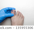 Medical pedicure treatment showing toe nail tamponade to prevent ingrown toenail. Podiatry procedure with cotton packing, antiseptic care and nail correction. 135955306