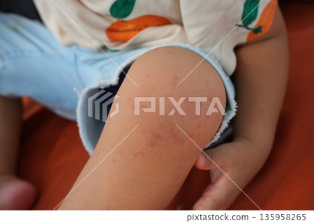 Hand foot and mouth disease (HFMD) rash and blisters on a child's hand and leg. Hand foot and mouth disease (HFMD) rash and blisters on a child's hand and leg. 135958265