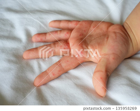 Hand foot and mouth disease (HFMD) rash and blisters on a child's hand and leg. 135958269