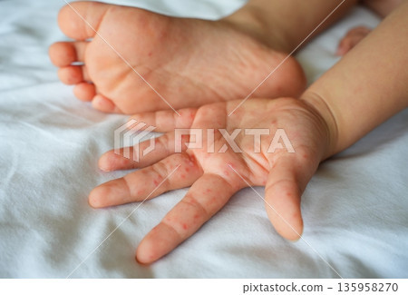 Hand foot and mouth disease (HFMD) rash and blisters on a child's hand and leg. 135958270